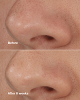 Clinique Blackhead Solutions Self-Heating Blackhead Extractor - 0.7 oz.
